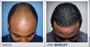 Read more about the article Bosley Hair Restoration Review From My Personal Experience