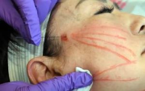 Read more about the article PDO Thread Lift Reviews From My Personal Experience