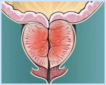 aquablation prostate