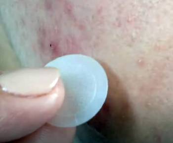 mighty patch dark spots